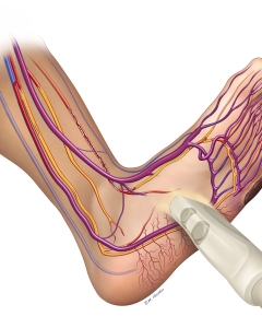 After the creation of an A-V fistula, blood flow circulates down the veins to revascularize the toes and foot and creating collateral vessels.