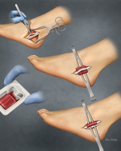 Peroneal tendon repair using sutures and a bone marrow aspirate implant.