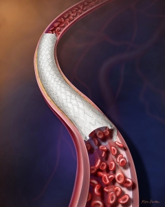 Depiction of a stent graft treating atherosclerotic disease in a peripheral artery.