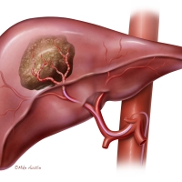 Radioembolization