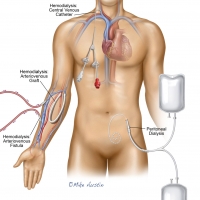 Dialysis Types