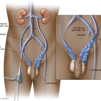 Varicocele Embolization