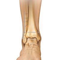 Ankle Syndesmosis