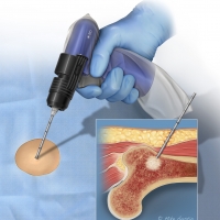 Illustration of a femoral bone lesion biopsy.