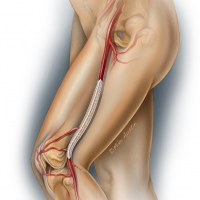 Drug eluting balloon in a peripheral artery