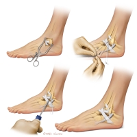 Lateral Ankle Instability