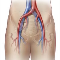 Venous Stent