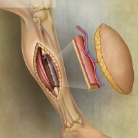 Fibular Skin (free) Flap