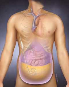 Placement of an ascites shunt to transfer fluid from the abdomen to the blood stream.