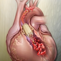 Valvuloplasty perfusion catheter that allows blood flow while the balloon is inflated.