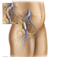 PAD Peripheral Artery Disease