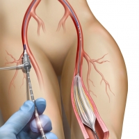 Balloon Angioplasty for Peripheral Artery Disease.