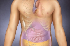 Placement of an ascites shunt to transfer fluid from the abdomen to the blood stream.