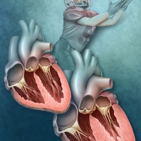 Hypertrophic Cardiomyopathy