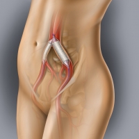 Iliac Artery Stents