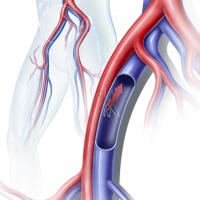 Iliac/Femoral Fistula