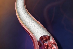 Depiction of a stent graft treating atherosclerotic disease in a peripheral artery.