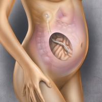 Implantable Peritoneal Port