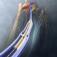 Saphenous Vein Ablation