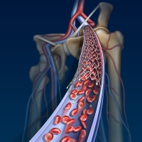 Venous stent